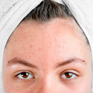 Productos-Naturales-Acne