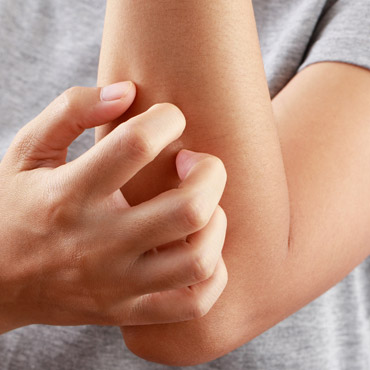 Productos-Naturales-para-Psoriasis